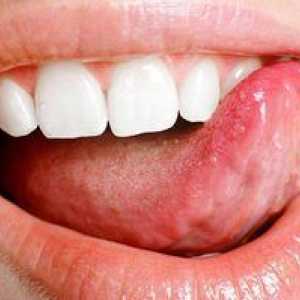 Kako zdraviti stomatitis v jeziku: opis in metode zdravljenja pri odraslih
