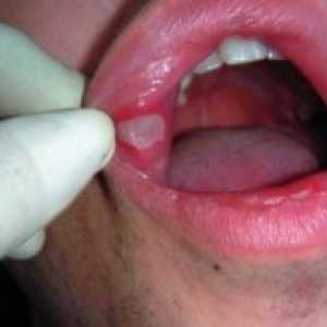 Kako zdraviti vnetje ustne sluznice: sredstva in metode zdravljenja