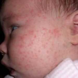 Kako se alergija na hrani kaže pri otroku, kot pa pri zdravljenju izpuščajev na obrazu