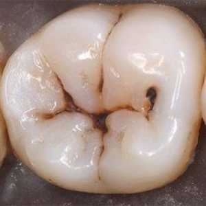 Zobni karies: faze in vzroki razvoja, kako zdraviti