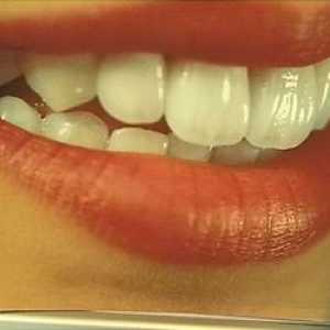 Keramični zobje: kaj je to, prednosti keramičnih kron