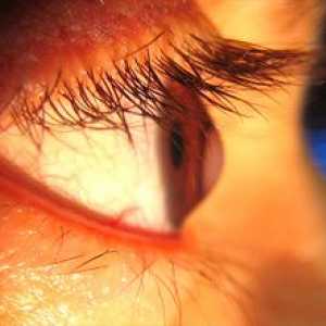Keratokonus očesa: konzervativno in kirurško zdravljenje