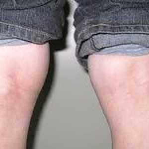 Beckerjeva cista pod kolenom - kako nevarna in kako zdraviti?