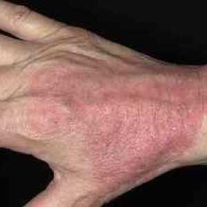 Zdravljenje atopičnega dermatitisa pri odraslih