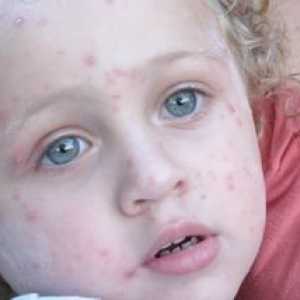 Zdravljenje herpesa pri otrocih, fotografija zunanjih manifestacij patologije