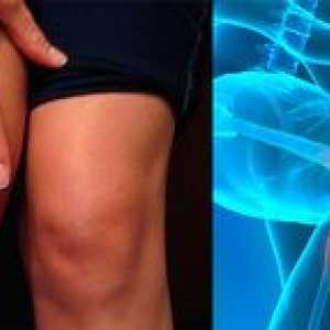 Zdravljenje gonarthroze kolenskega sklepa 2. stopnje: znaki bolezni