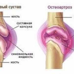 Zdravljenje osteoartritisa kolena 2. stopnje