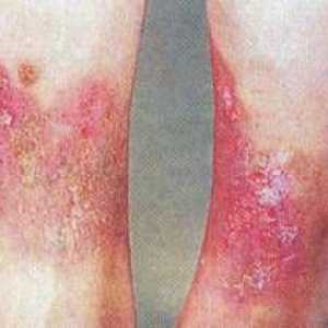 Lipodermatoskleroza ali varikozni dermatitis: simptomi