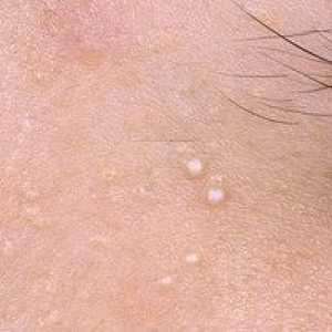 Mylium na obrazu: znebiti se patsyja, fotografije črnih glav na koži