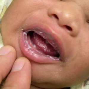 Utrujenost v ustih pri zdravljenju dojenčka