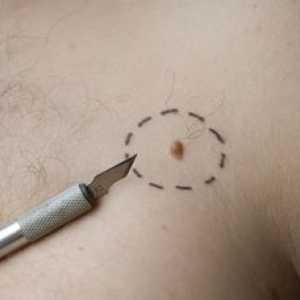 Neoplazme na koži: fotografije, vrste in metode zdravljenja