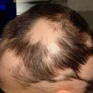 Alopecia areata (plešavost): manifestacije bolezni in zdravljenje