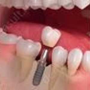 Takojšnja implantacija zob: cene in opis metode