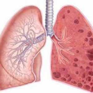 Glavni simptomi in zdravljenje bolusne bolezni (emfizemov) pljuč