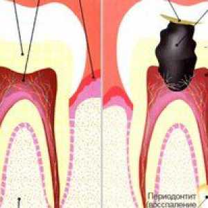 Akutni periodontitis: vzroki, simptomi in zdravljenje