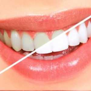 Izboljšanje zob z vodikovim peroksidom doma