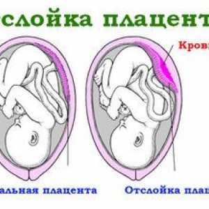 Placentalna prekinitev v zgodnji nosečnosti