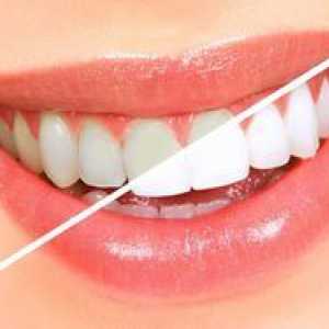 Platišča za beljenje zob: indikacije in kontraindikacije