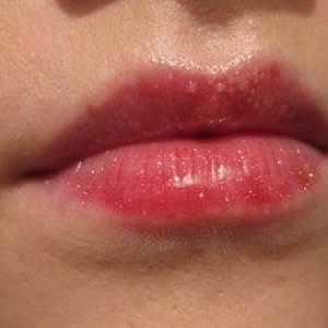 Zakaj se na ustnicah pojavijo bele pike?