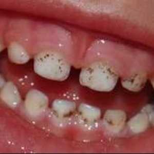 Zakaj se na zobah pojavijo črne pike in kako se lahko zdravijo?