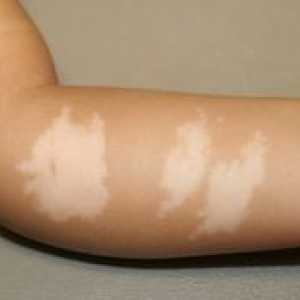 Pojav belih madežev na koži otroka: anamneza in posledice