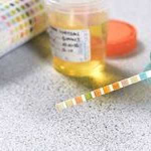 Povečana vsebnost beljakovin v urinu, kaj to pomeni?