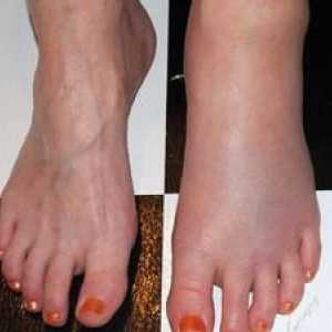 Vzroki bolečin v nogah: vrste bolezni in zdravljenje