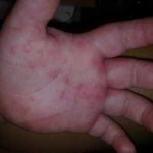 Vzroki za srbenje rdečih pik na roki