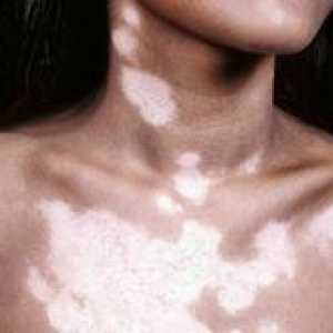 Vzroki za pojav belih madežev na koži otroka