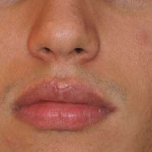 Vzroki za nastanek bolezni Fordisovih zrn na ustnicah