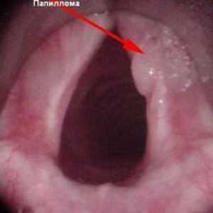 Vzroki za nastanek papiloma v grlu pri otrocih in njihovo zdravljenje