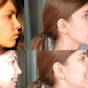 Prognatna distalna okluzija: fotografije pred in po prsih