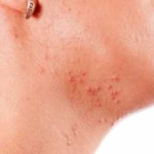 Akne na vratu pri ženskah: vzroki za izpuščaje
