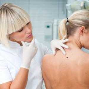Akne na hrbtu: vzroki za pojav pri ženskah in zdravljenje