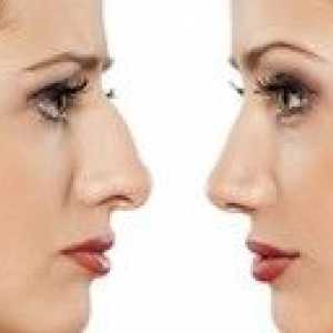 Rinoplastika: značilnosti plastične kirurgije na nosu