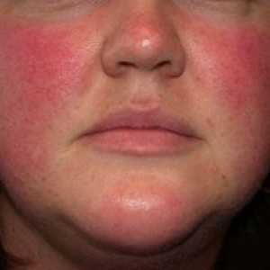 Rosacea na obrazu: simptomi, metode zdravljenja in fotografije