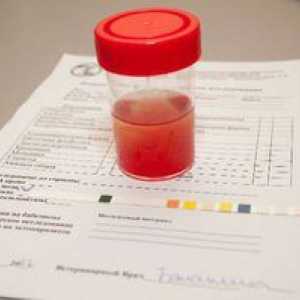 Sladkor v urinu otroka: vzroki in kaj to pomeni?