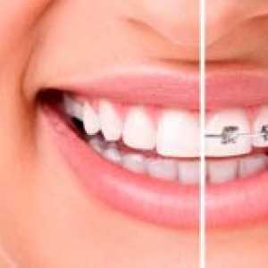 Self-ligating braces: lastnosti in prednosti