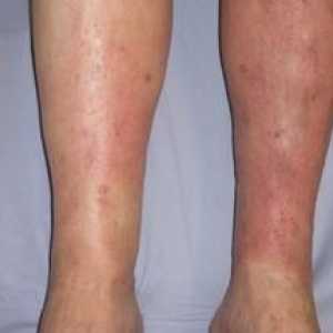 Simptomi in zdravljenje dermatitisa na nogah, foto