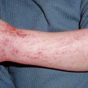 Simptomi in zdravljenje dermatitisa pri odraslih, foto