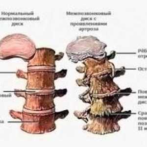 Simptomi in zdravljenje osteohondroze ledvene hrbtenice