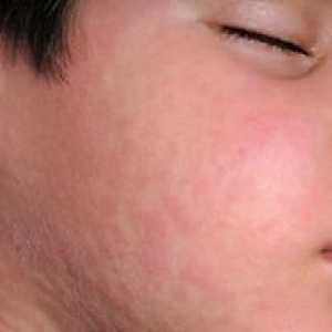 Simptomi in zdravljenje mumps pri otrocih