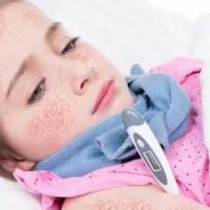 Škrlatna vročina pri otrocih: simptomi in zdravljenje, foto
