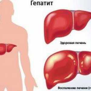 Koliko let lahko oseba živi, ​​ko je kronični hepatitis
