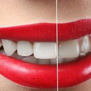 Koliko stane beljenje laserskih zob?
