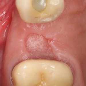 Koliko popravi dlesni po ekstrakciji zoba?