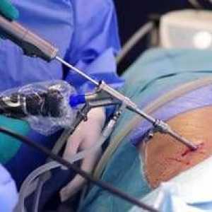 Posebnost zdravljenja medvretenčne kile ledvične regije brez kirurškega posega