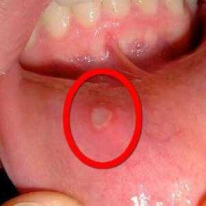 Stafilokoki v ustih: simptomi, načini zdravljenja, fotografija