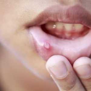Stomatitis v ustih: zaradi tega, kar se zgodi in kako zdraviti