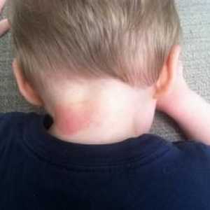 Izpuščaji v vratu pri odraslih in otrocih: vzroki in metode boja